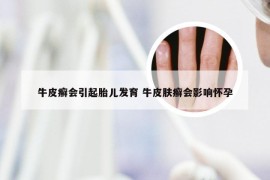 牛皮癣会引起胎儿发育 牛皮肤癣会影响怀孕