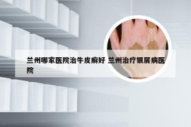 兰州哪家医院治牛皮癣好 兰州治疗银屑病医院