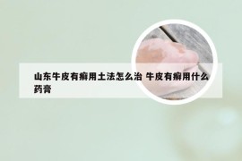 山东牛皮有癣用土法怎么治 牛皮有癣用什么药膏