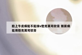 脸上牛皮癣能不能抹v他克莫司软膏 银屑病能用他克莫司软膏