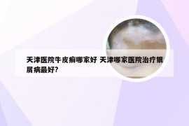 天津医院牛皮癣哪家好 天津哪家医院治疗银屑病最好?