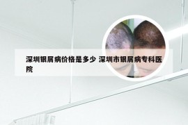 深圳银屑病价格是多少 深圳市银屑病专科医院