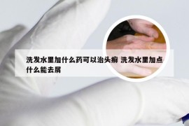 洗发水里加什么药可以治头癣 洗发水里加点什么能去屑