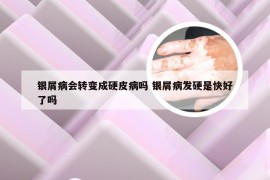 银屑病会转变成硬皮病吗 银屑病发硬是快好了吗