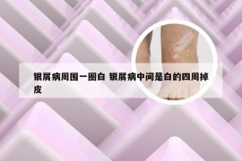 银屑病周围一圈白 银屑病中间是白的四周掉皮