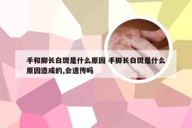 手和脚长白斑是什么原因 手脚长白斑是什么原因造成的,会遗传吗