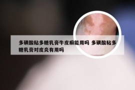 多磺酸粘多糖乳膏牛皮癣能用吗 多磺酸粘多糖乳膏对皮炎有用吗