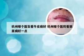 杭州哪个医生看牛皮癣好 杭州哪个医院看银屑病好一点