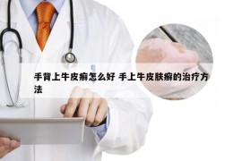 手背上牛皮癣怎么好 手上牛皮肤癣的治疗方法