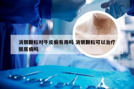 消银颗粒对牛皮癣有用吗 消银颗粒可以治疗银屑病吗