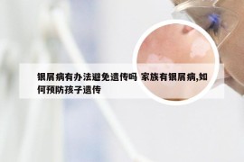 银屑病有办法避免遗传吗 家族有银屑病,如何预防孩子遗传