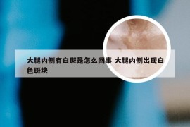 大腿内侧有白斑是怎么回事 大腿内侧出现白色斑块