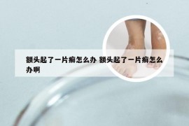 额头起了一片癣怎么办 额头起了一片癣怎么办啊