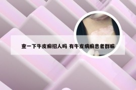 查一下牛皮癣招人吗 有牛皮病癣患者群嘛