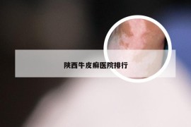 陕西牛皮癣医院排行