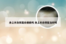 身上长白斑是白癫疯吗 身上长白斑能治好吗