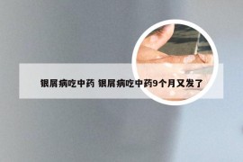 银屑病吃中药 银屑病吃中药9个月又发了