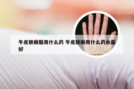 牛皮肤癣服用什么药 牛皮肤癣用什么药水最好