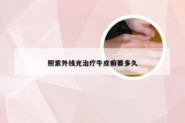 照紫外线光治疗牛皮癣要多久