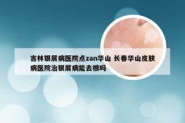 吉林银屑病医院点zan华山 长春华山皮肤病医院治银屑病能去根吗