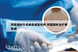 阿莫西林牛皮癣患者能吃吗 阿莫西林治疗银屑病