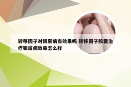 转移因子对银屑病有效果吗 转移因子胶囊治疗银屑病效果怎么样