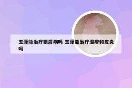 玉泽能治疗银屑病吗 玉泽能治疗湿疹和皮炎吗