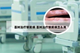 喜树治疗银屑病 喜树治疗银屑病怎么用