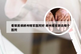 看银屑病郴州哪家医院好 郴州看皮肤去哪个医院