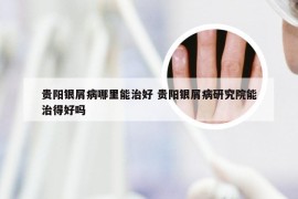 贵阳银屑病哪里能治好 贵阳银屑病研究院能治得好吗