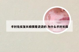 手肘处反复长癣摸着烫烫的 为什么手肘长藓