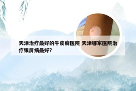 天津治疗最好的牛皮癣医院 天津哪家医院治疗银屑病最好?