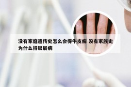 没有家庭遗传史怎么会得牛皮癣 没有家族史为什么得银屑病