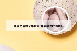 淋病之后得了牛皮癣 淋病会皮肤溃烂吗