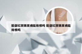 脸部红斑银屑病能除根吗 脸部红斑银屑病能除根吗