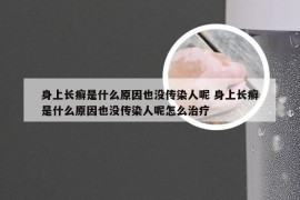 身上长癣是什么原因也没传染人呢 身上长癣是什么原因也没传染人呢怎么治疗