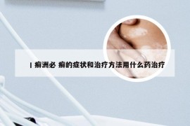 丨癣洲必 癣的症状和治疗方法用什么药治疗