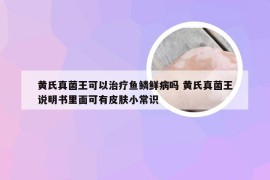 黄氏真菌王可以治疗鱼鳞鲜病吗 黄氏真菌王说明书里面可有皮肤小常识