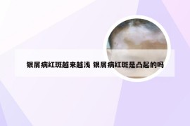 银屑病红斑越来越浅 银屑病红斑是凸起的吗