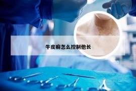 牛皮癣怎么控制他长