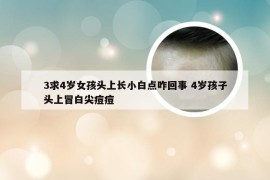 3求4岁女孩头上长小白点咋回事 4岁孩子头上冒白尖痘痘