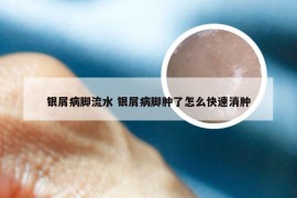 银屑病脚流水 银屑病脚肿了怎么快速消肿