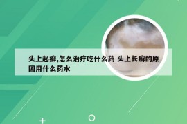 头上起癣,怎么治疗吃什么药 头上长癣的原因用什么药水