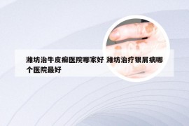 潍坊治牛皮癣医院哪家好 潍坊治疗银屑病哪个医院最好