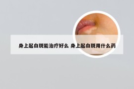 身上起白斑能治疗好么 身上起白斑用什么药