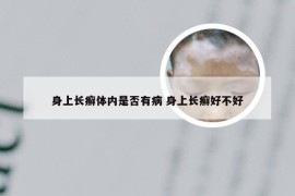 身上长癣体内是否有病 身上长癣好不好