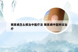 银屑病怎么根治中医疗法 银屑病中医辨证治疗