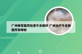 广州哪家医院检查牛皮癣好 广州治疗牛皮鲜医院有哪些