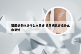 银屑病多吃点什么水果好 银屑病患者吃什么水果好