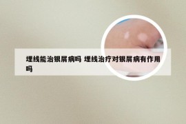 埋线能治银屑病吗 埋线治疗对银屑病有作用吗